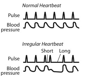 normal heartbeat vs irregular heartbeat